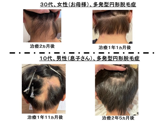 円形脱毛症　病院